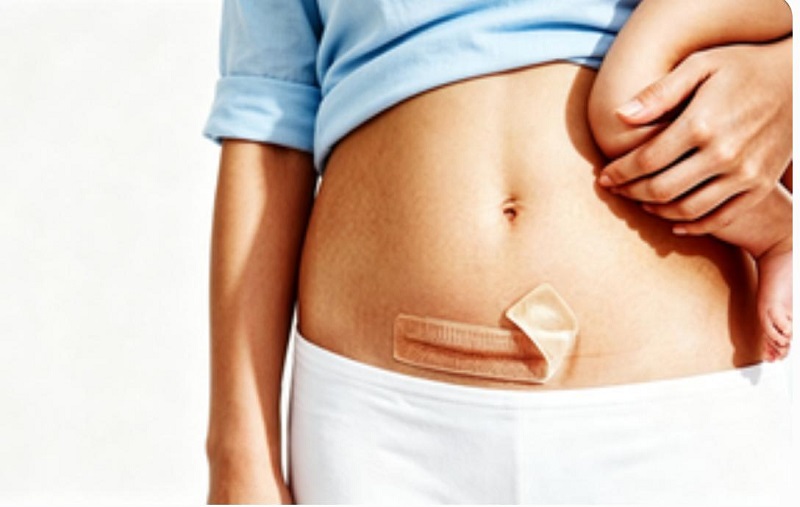 Bezpečná CmallBio silikonová náplast na jizvy bez obsahu hormonů pro péči o jizvy po císařském řezu